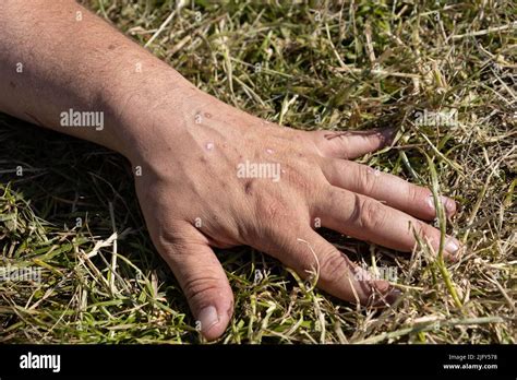 mild case  psoriasis  eczema  hands stock photo alamy
