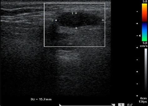 Ultrasonography Shows A Slight Dilation Of Left Submandibular Gland