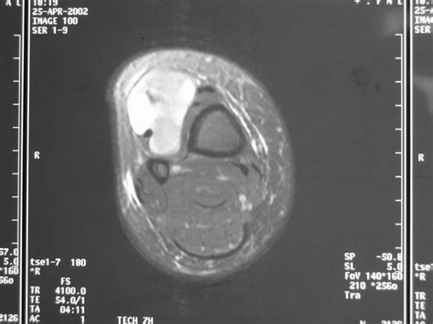 Synovial Sarcoma Soft Tissue Sarcoma