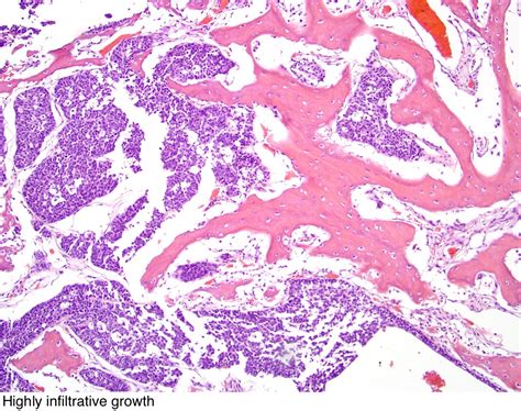 Pathology Outlines Nut Carcinoma