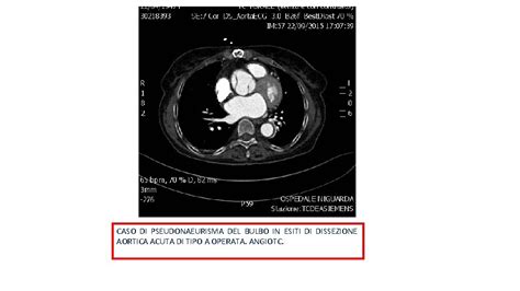 Imaging Nelle Sindromi Aortiche Pocket Book