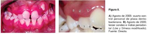 Enfermedad Periodontal En Pacientes Adolescentes Con S Ndrome De Down