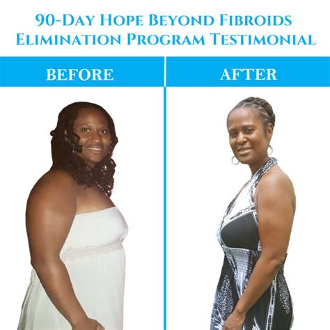 How One Woman Eliminated 50 Fibroids Without Surgery | BlackDoctor