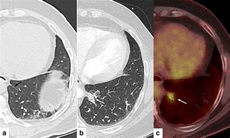 A-C. 65-year-old asymptomatic female with biopsy-proven granulomatous ...