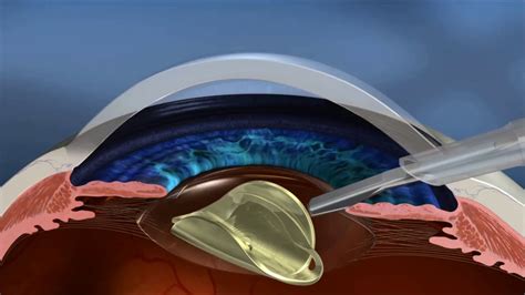 What Instruments Are Used In Cataract Surgery At Beth Lunsford Blog