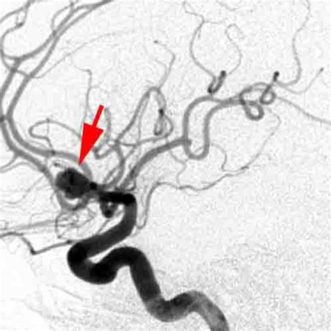 Cerebral Angiogram Shows The Aneurysm Arrows That Was Responsible For The Bleed