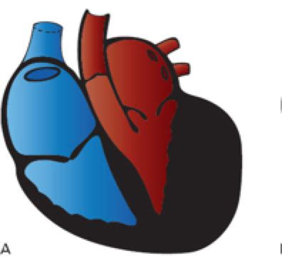 Ekg Hypertrophy And Enlargement Flashcards Quizlet