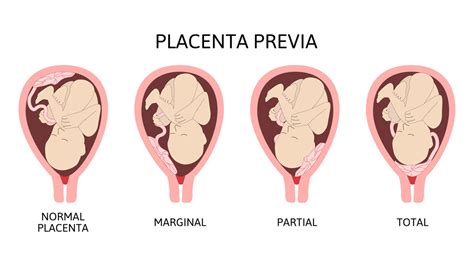 Placenta Previa Kwma