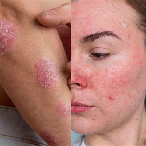 Eczema Vs Rosacea How To Tell The Difference