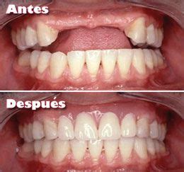 Implantes Dentales En Cdmx Cl Nica Dental Dr Molina Implantes