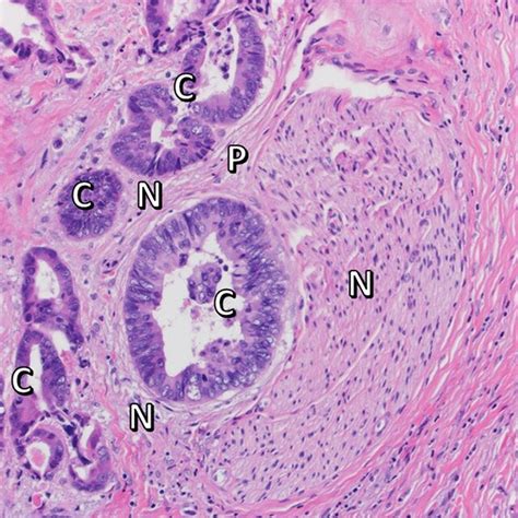 Histopathological Findings Of Perineural Invasion Invasive Cancer Foci