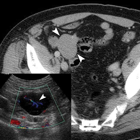 Ultrasound Imaging Of Bowel Pathology Technique And Keys To Diagnosis