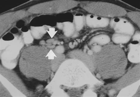 Mesenteric Adenitis Ct Diagnosis Of Primary Versus Secondary Causes Incidence And Clinical