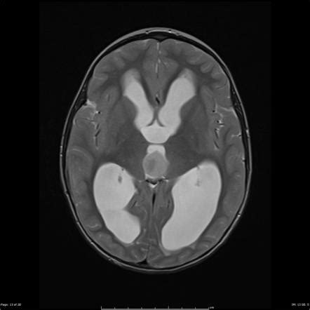 Ependymoma (posterior third ventricle) | Radiology Case | Radiopaedia.org