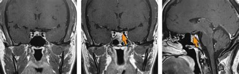 Finding the Right Solutions for Pituitary Tumors | California Center ...