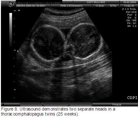 📃 MRI, Conjoined twins