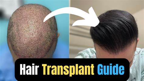 News: A Guide To Getting A Successful Hair Transplant