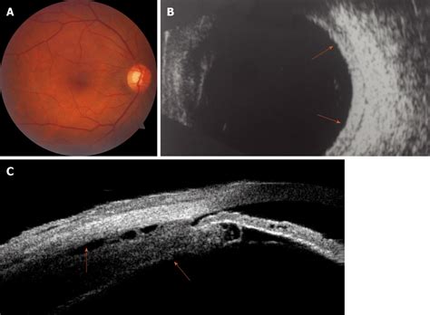 Color Fundus Imaging B Scan Ultrasonography And Ultrasound