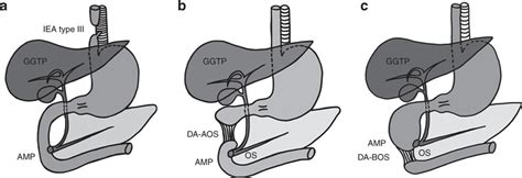 Anatomical Description Of Esophageal Atresia Type Iii And Of The Two