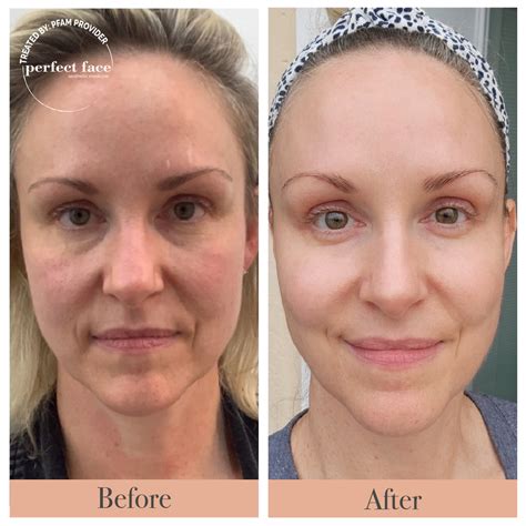 Radiofrequency Microneedling Or Morpheus 8 Is There A Difference