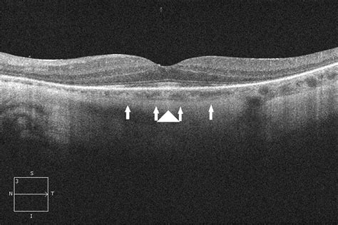 Autoimmune Retinopathy American Journal Of Ophthalmology