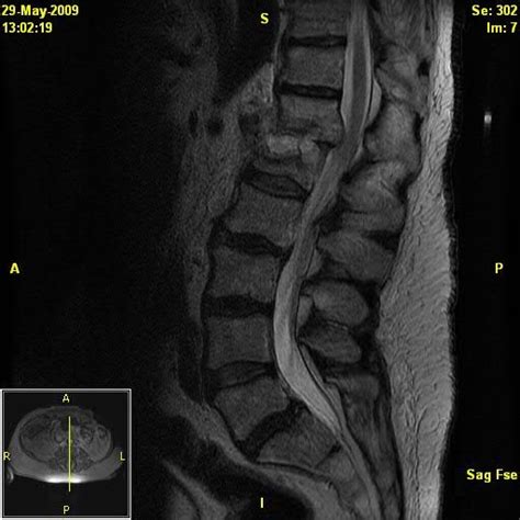 Lumbar Spine Mri Labeled