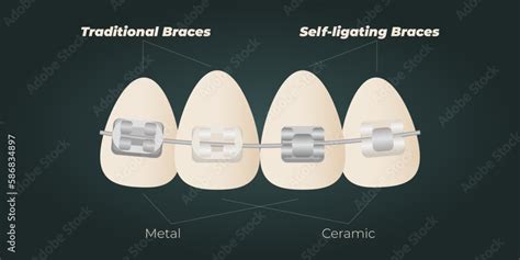 The concept of teeth alignment with braces. Orthodontic dentistry. The ...