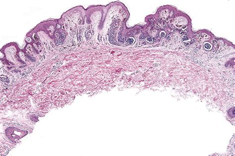 My Approach To Atypical Melanocytic Lesions Journal Of Clinical Pathology