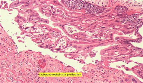 Pathology Outlines Invasive Hydatidiform Mole