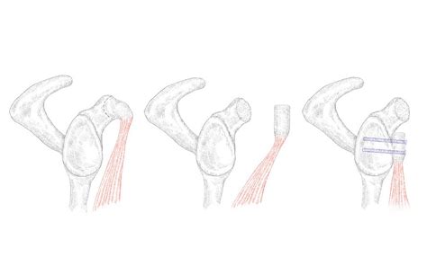 Cirurgia De Reparação Da Luxação Recidivante Do Ombro Ortopedistas