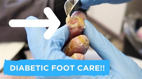 Taking The Nail Off Diabetic Foot Care Youtube