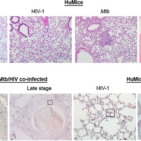 Hiv Co Infection Exacerbates Mtb Pathology In Humouse Lung