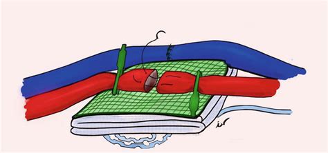 Basic Principles In Microvascular Anastomosis And Free Tissue Transfer