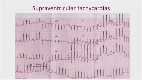 Sex Differences In Cardiac Arrhythmias Youtube