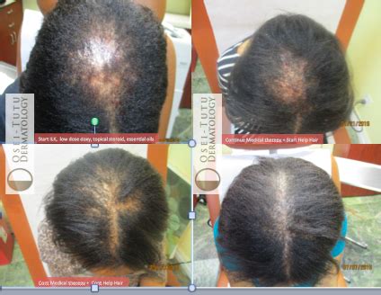 Central Centrifugal Cicatricial Alopecia (CCCA). What is CCCA? - Help Hair