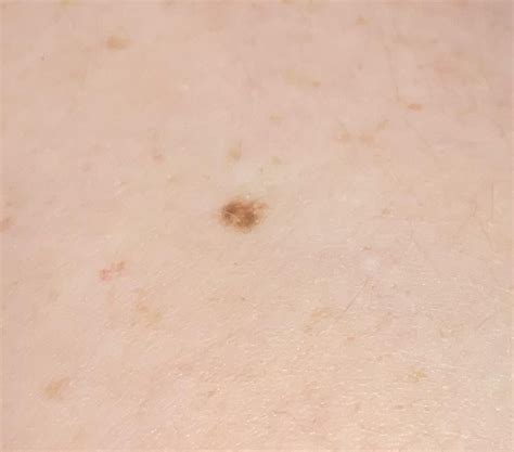 these two freckles are worrying me : r/skincancer