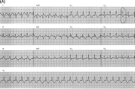 PDF Application Of A New Algorithm In The Differential Diagnosis Of