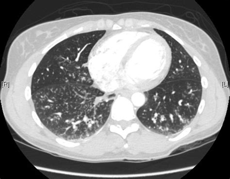 Cold case: Bedside diagnosis of Mycoplasma pneumonia | Journal of Hospital Medicine