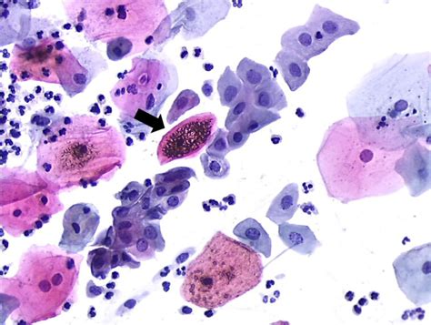 Endocervical Squamous Metaplastic Cells