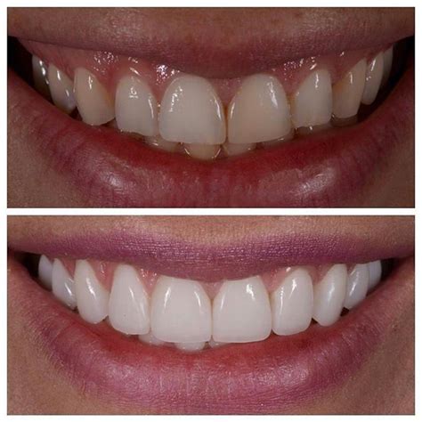 Porcelain Veneers