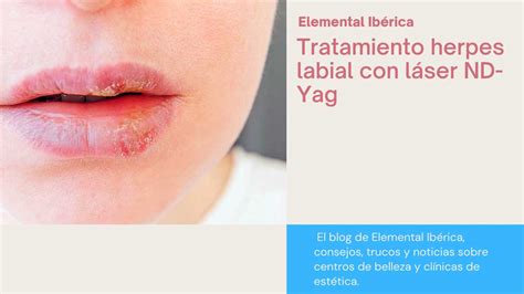 Tratamiento Herpes Labial Con L Ser Nd Yag