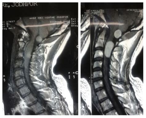 Mri Of Cervical Spine Sagittal Plane Mri Magnetic Resonance Imaging