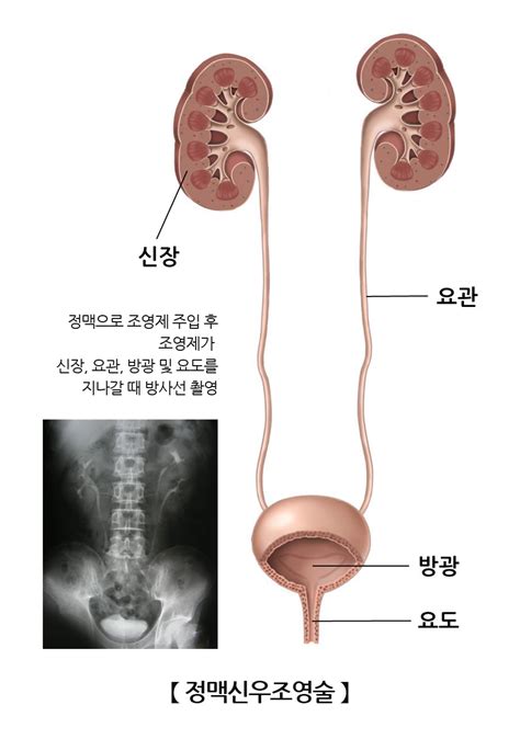 정맥신우조영술 검사시술수술 정보 의료정보 건강정보 서울아산병원