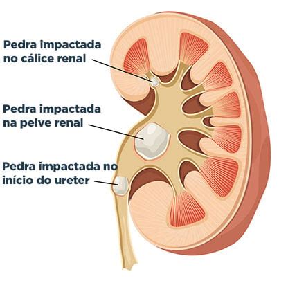 Cálculo renal pedra no rim causas tipos e tratamento 2022