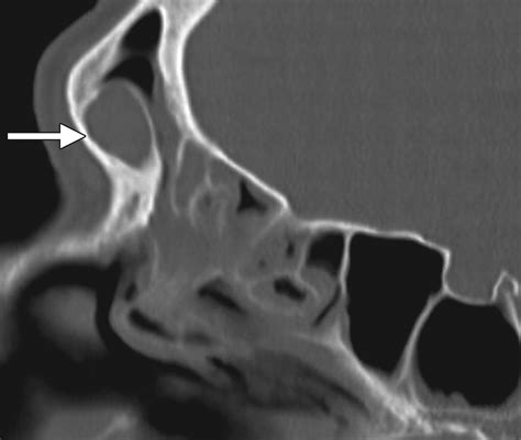 Failed Endoscopic Sinus Surgery Spectrum Of Ct Findings In The Frontal