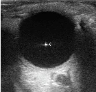 Asteroid Hyalosis Seen on Ocular Point-of-Care Ultrasound - The Western ...