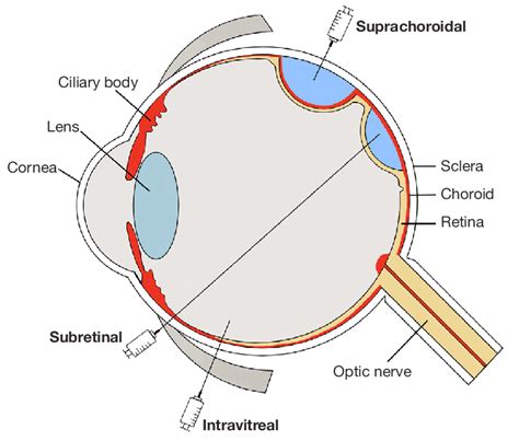 A Schematic Diagram Illustrating 3 Different Intraocular Injection