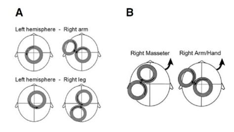 The Importance Of Tms Coil Placement