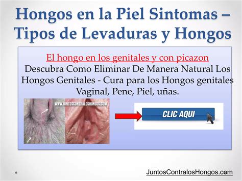 Hongos En La Piel Sintomas Tipos De Levaduras Y Hongos Ppt