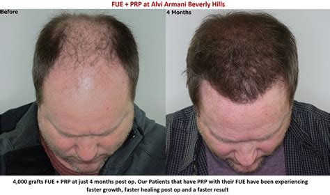 Top 126 Is Prp Must After Hair Transplant Polarrunningexpeditions